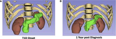 Quantitative Magnetic Resonance Imaging of the Pancreas of Individuals With Diabetes